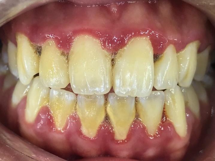 Dental calculus buildup on teeth near gumline showing tartar that requires professional scaling to prevent gum recession