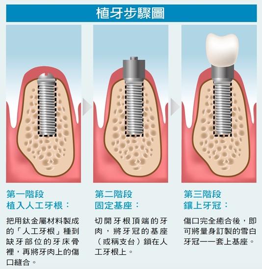 不同品牌牙科植體排列比較，展示香港種牙植體選擇與價錢差異